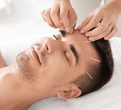 Fine acupuncture needles being placed during a treatment session